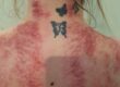 Gua Sha St Helens